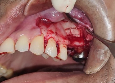 Sinus lift  by lateral window technique