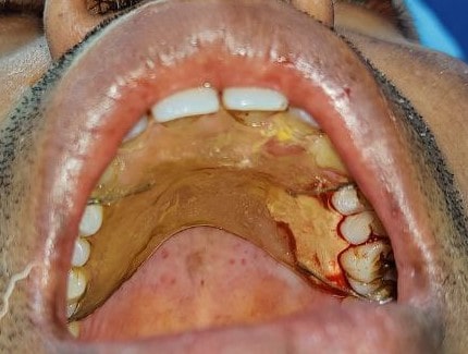 Gingival unit graft for root coverage