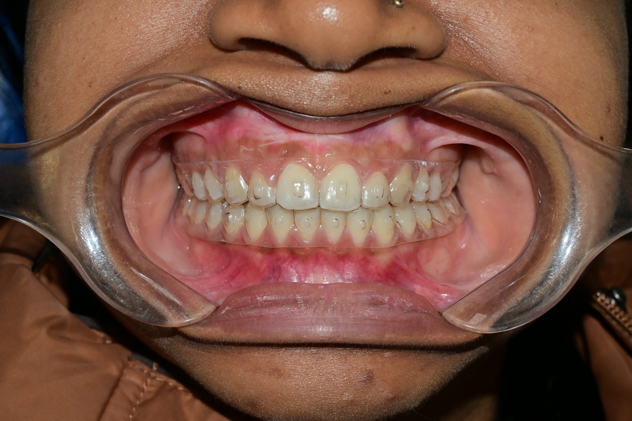 Clear Aligner Therapy