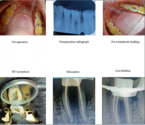 ENDO PERIO LESION MANAGEMENT