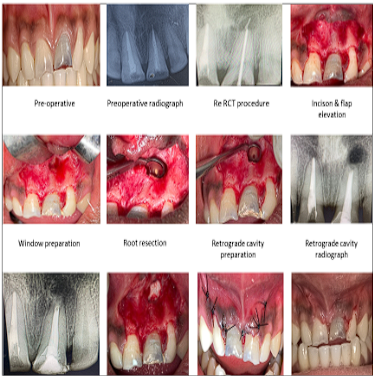 ENDODONTIC SURGERY PERIAPICAL