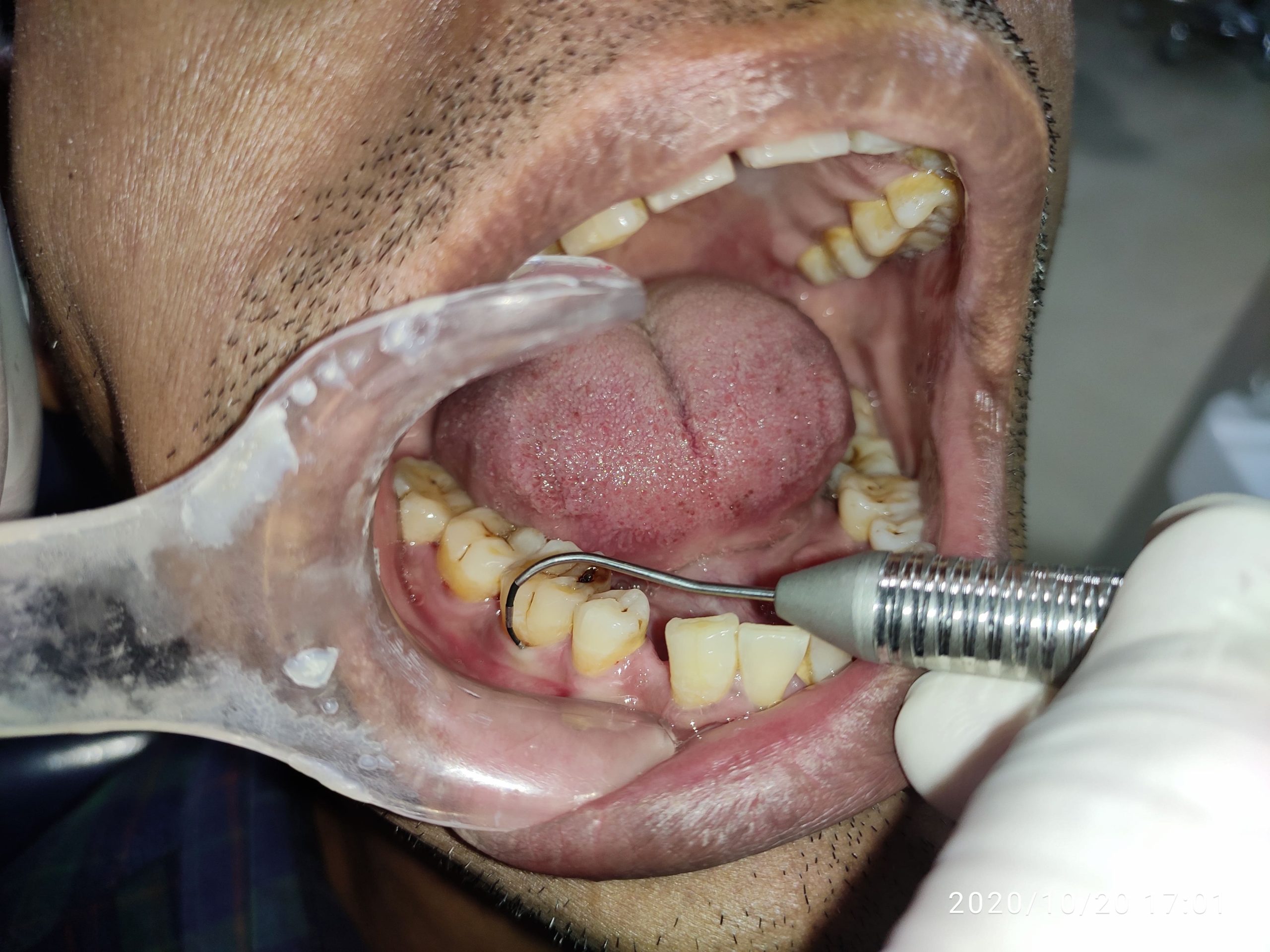 Root Resection