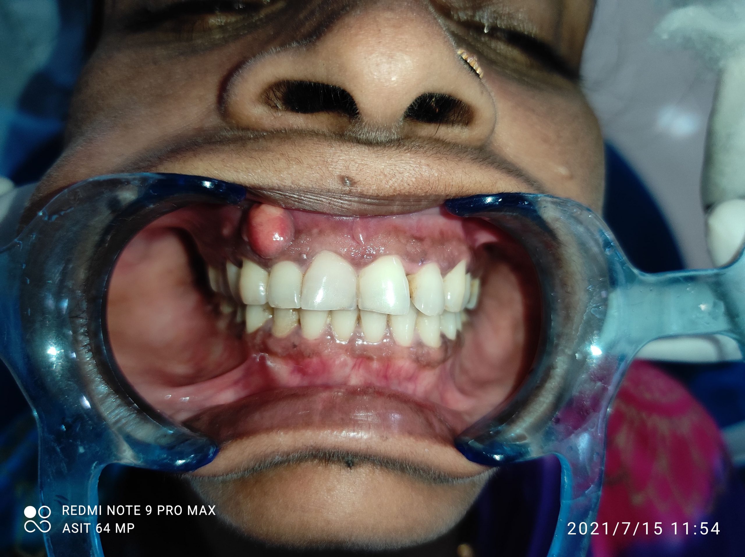Mucormycosis