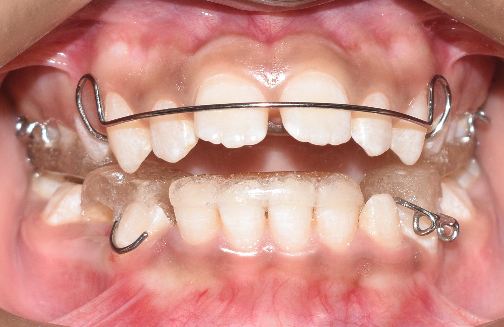 Functional Appliance Therapy