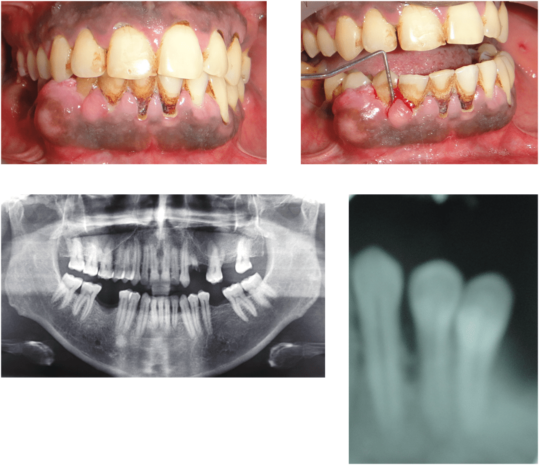 Peripheral ameloblastoma