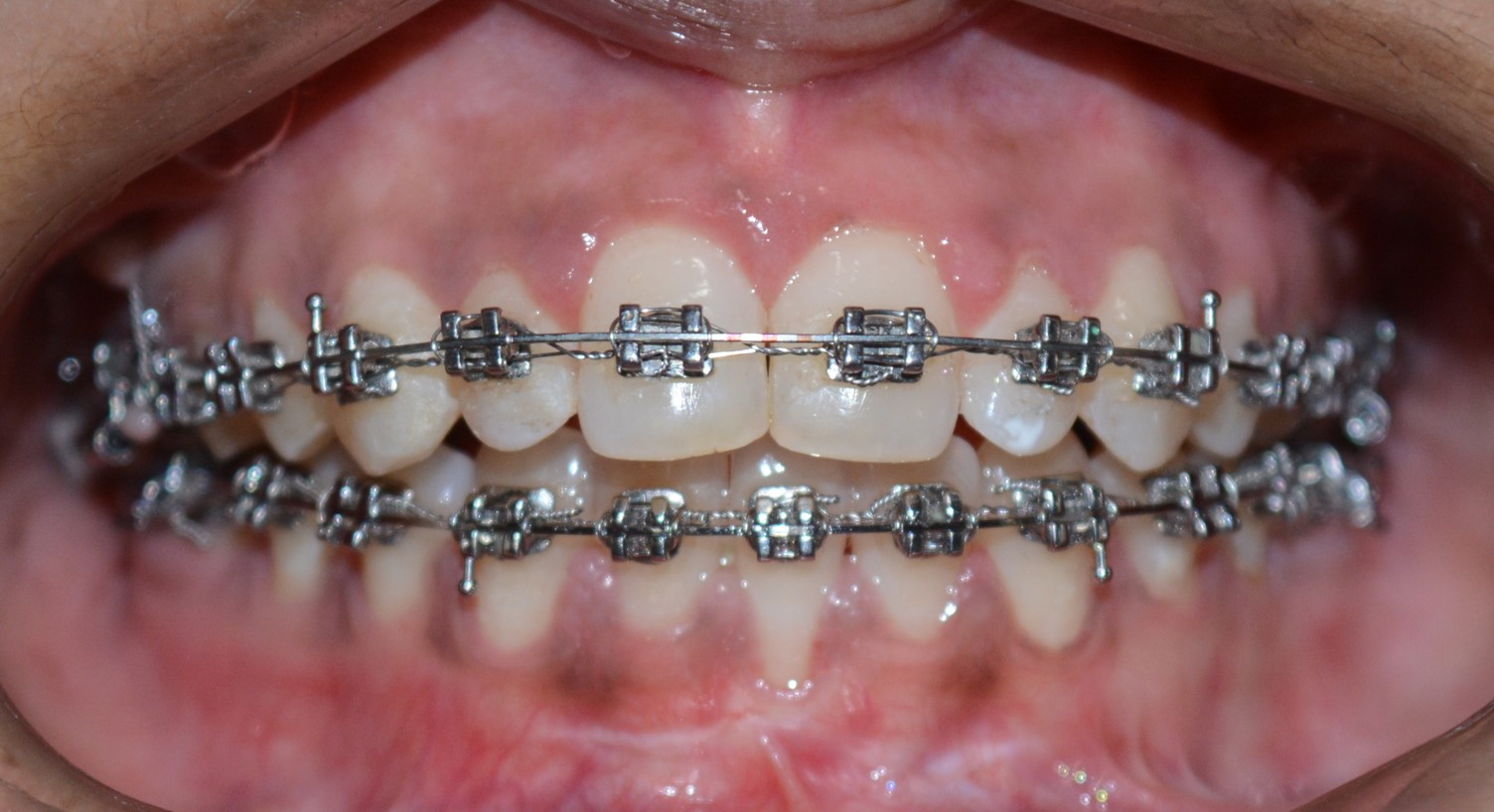 Ortho-Perio Interdsciplinary Case