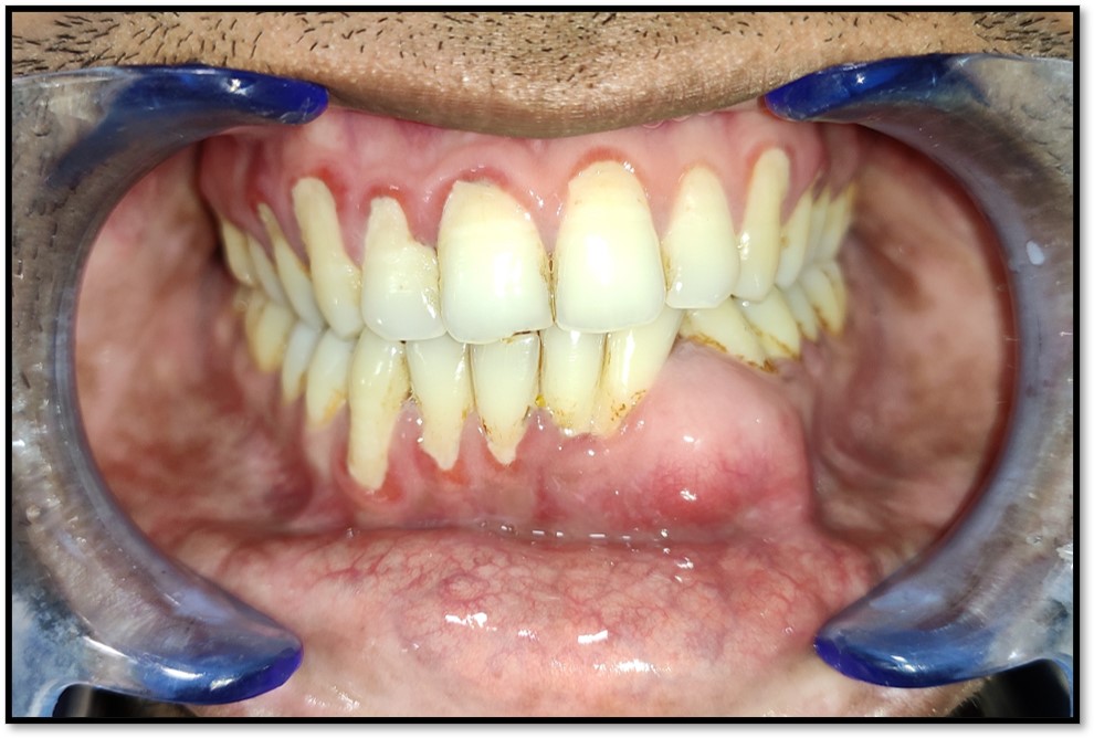 Peripheral Ameloblastoma