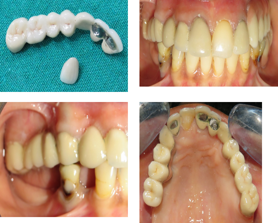 Prostho-Perio Interdisciplinary Case