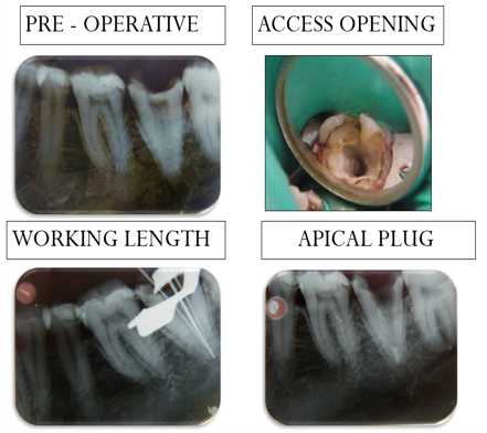 MANAGEMENT OF ENDOCASES WITH ABBERENT ANATOMY