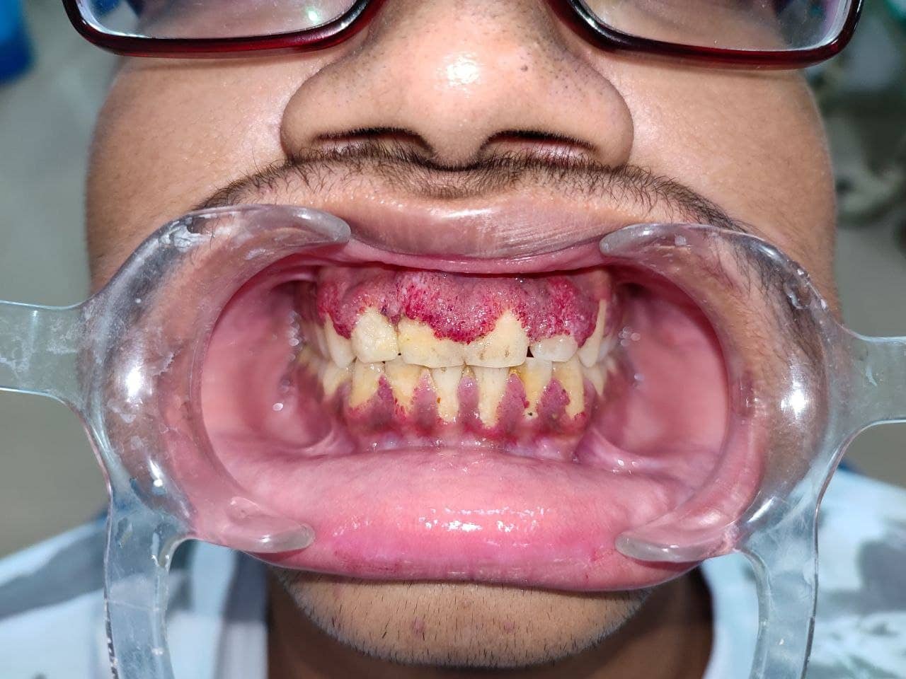 Wegners Granulomatosis